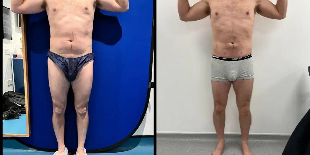 Calf augmentation enhances the shape and volume of the calves for a more masculine contour, through the use of medical-grade silicone implants, fat transfer, or a combination of both methods. Calf Implants And Augmentation For Trans Men &Amp; Nonbinary Individuals