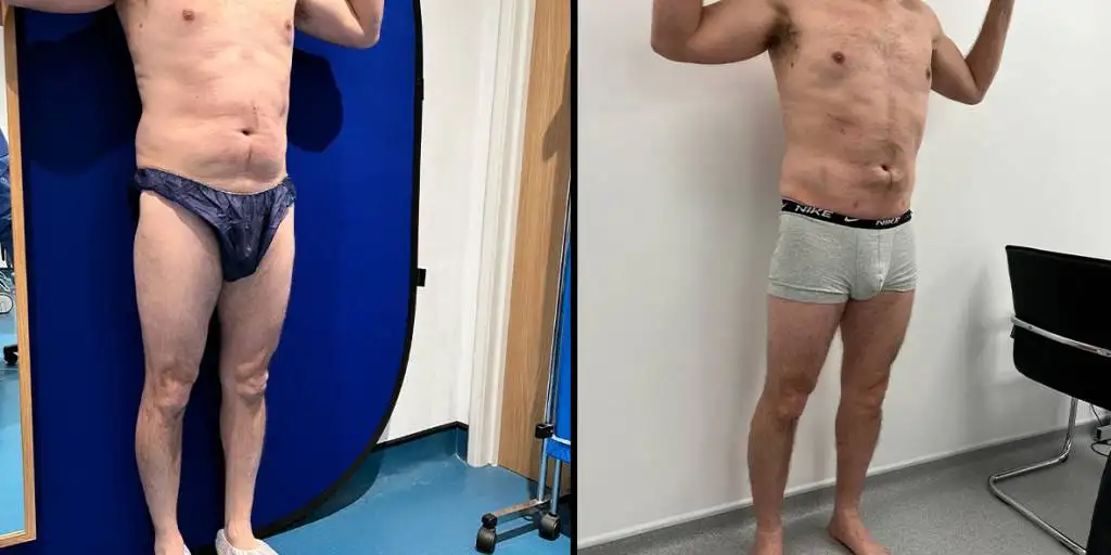 Calf augmentation enhances the shape and volume of the calves for a more masculine contour, through the use of medical-grade silicone implants, fat transfer, or a combination of both methods. Calf Implants And Augmentation For Trans Men &Amp; Nonbinary Individuals