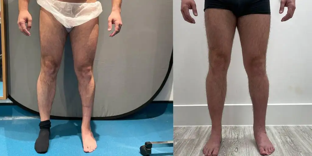 Calf augmentation enhances the shape and volume of the calves for a more masculine contour, through the use of medical-grade silicone implants, fat transfer, or a combination of both methods. Calf Implants And Augmentation For Trans Men &Amp; Nonbinary Individuals