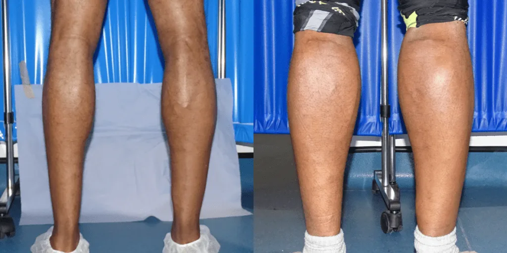 Calf augmentation enhances the shape and volume of the calves for a more masculine contour, through the use of medical-grade silicone implants, fat transfer, or a combination of both methods. Calf Implants And Augmentation For Trans Men &Amp; Nonbinary Individuals