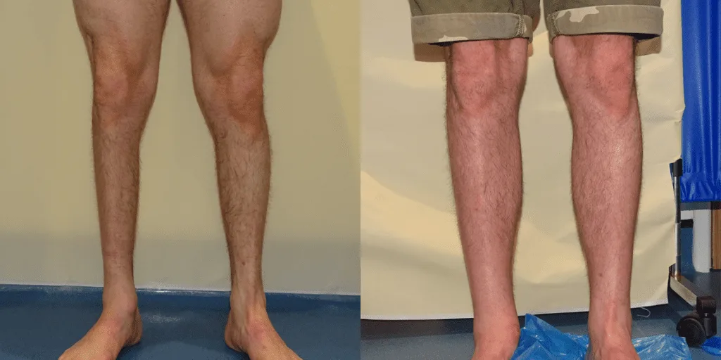 Calf augmentation enhances the shape and volume of the calves for a more masculine contour, through the use of medical-grade silicone implants, fat transfer, or a combination of both methods. Calf Implants And Augmentation For Trans Men &Amp; Nonbinary Individuals