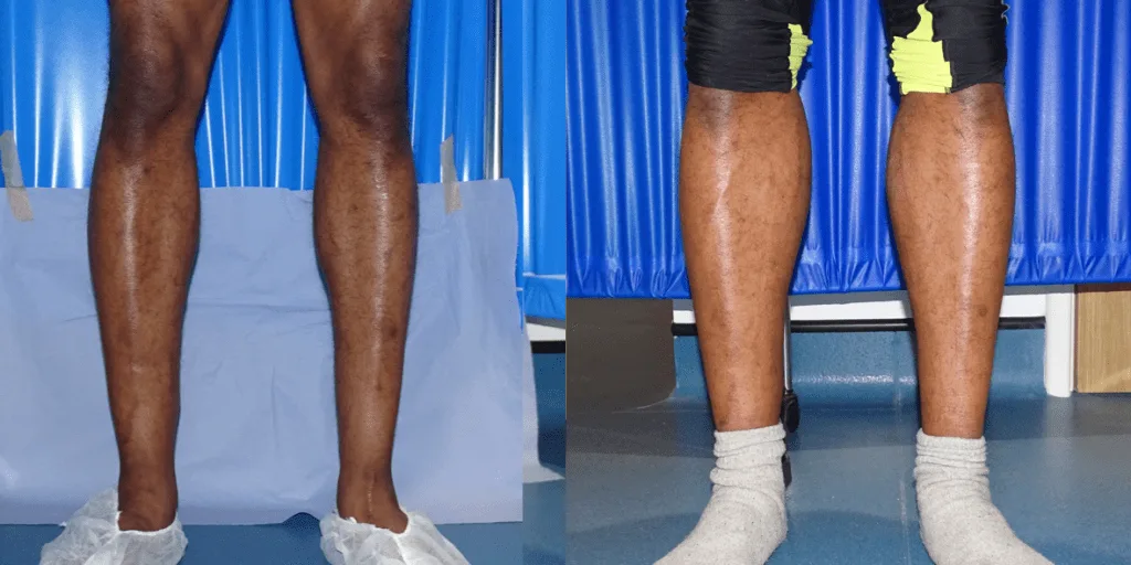 Calf augmentation enhances the shape and volume of the calves for a more masculine contour, through the use of medical-grade silicone implants, fat transfer, or a combination of both methods. Calf Implants And Augmentation For Trans Men &Amp; Nonbinary Individuals