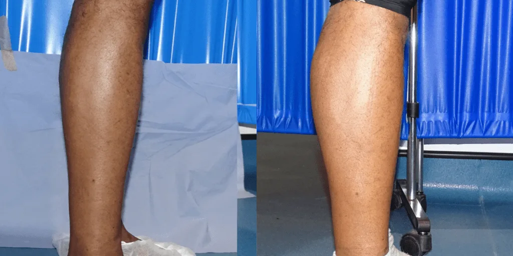 Calf augmentation enhances the shape and volume of the calves for a more masculine contour, through the use of medical-grade silicone implants, fat transfer, or a combination of both methods. Calf Implants And Augmentation For Trans Men &Amp; Nonbinary Individuals