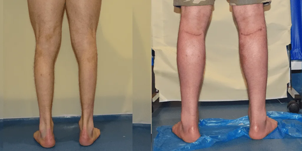 Calf augmentation enhances the shape and volume of the calves for a more masculine contour, through the use of medical-grade silicone implants, fat transfer, or a combination of both methods. Calf Implants And Augmentation For Trans Men &Amp; Nonbinary Individuals
