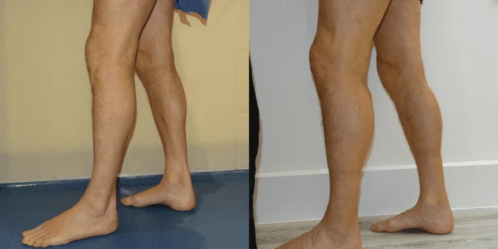 Calf augmentation enhances the shape and volume of the calves for a more masculine contour, through the use of medical-grade silicone implants, fat transfer, or a combination of both methods. Calf Implants And Augmentation For Trans Men &Amp; Nonbinary Individuals