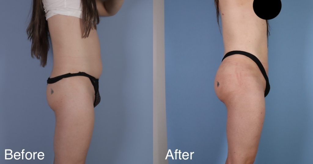 A Brazilian Butt Lift, or BBL, is a body contouring procedure that can be tailored to transgender, non-binary and gender non-conforming patients that wish to enhance their lower body to better reflect their gender identity. Transgender Brazilian Butt Lift In London