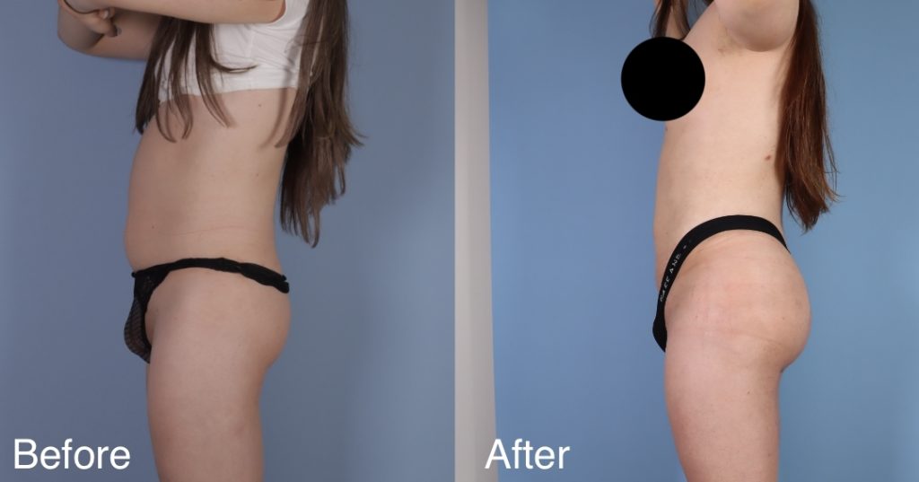 A Brazilian Butt Lift, or BBL, is a body contouring procedure that can be tailored to transgender, non-binary and gender non-conforming patients that wish to enhance their lower body to better reflect their gender identity. Transgender Brazilian Butt Lift In London