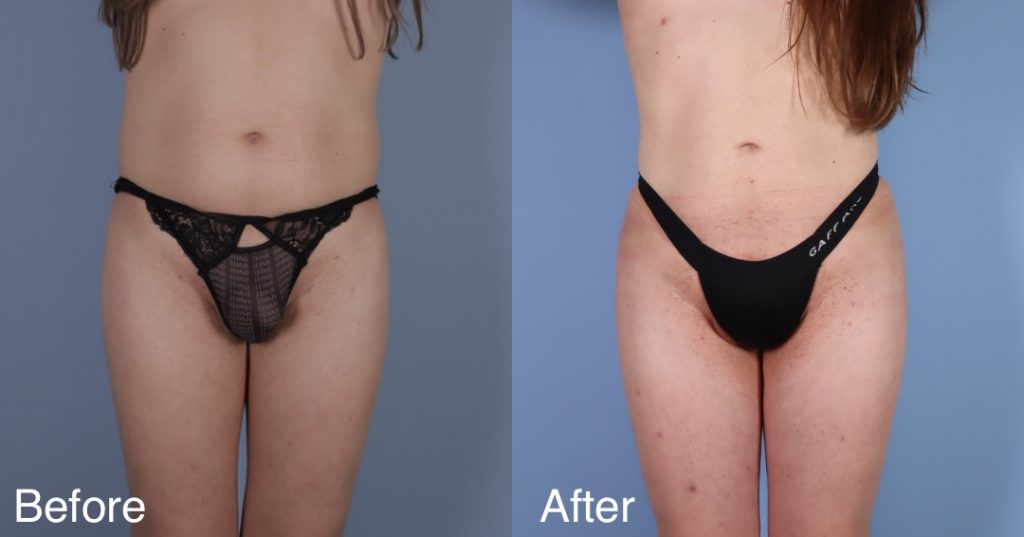 A Brazilian Butt Lift, or BBL, is a body contouring procedure that can be tailored to transgender, non-binary and gender non-conforming patients that wish to enhance their lower body to better reflect their gender identity. Transgender Brazilian Butt Lift In London