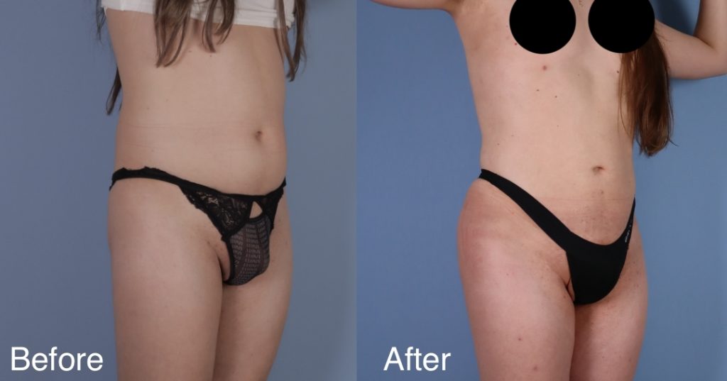 A Brazilian Butt Lift, or BBL, is a body contouring procedure that can be tailored to transgender, non-binary and gender non-conforming patients that wish to enhance their lower body to better reflect their gender identity. Transgender Brazilian Butt Lift In London