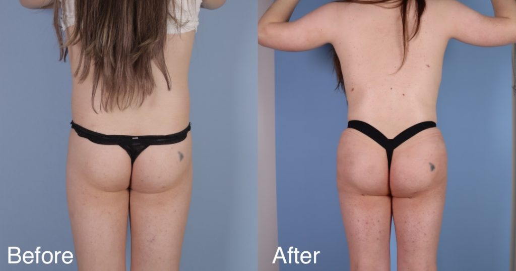 A Brazilian Butt Lift, or BBL, is a body contouring procedure that can be tailored to transgender, non-binary and gender non-conforming patients that wish to enhance their lower body to better reflect their gender identity. Transgender Brazilian Butt Lift In London