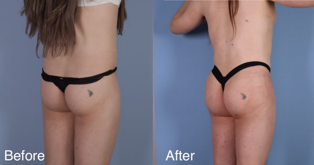 A Brazilian Butt Lift, or BBL, is a body contouring procedure that can be tailored to transgender, non-binary and gender non-conforming patients that wish to enhance their lower body to better reflect their gender identity. Transgender Brazilian Butt Lift In London