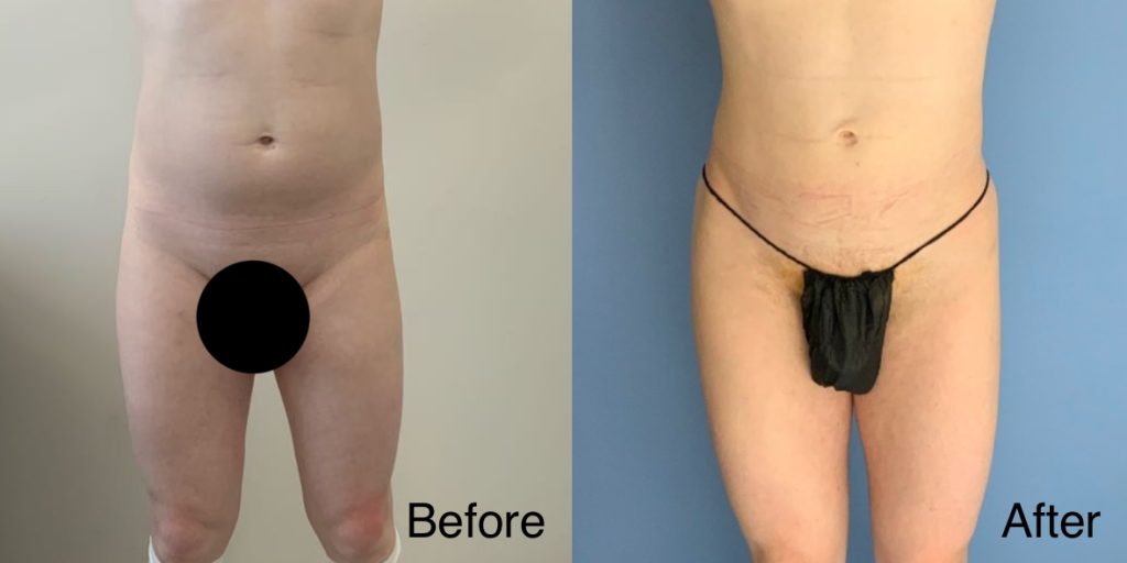 A Brazilian Butt Lift, or BBL, is a body contouring procedure that can be tailored to transgender, non-binary and gender non-conforming patients that wish to enhance their lower body to better reflect their gender identity. Transgender Brazilian Butt Lift In London