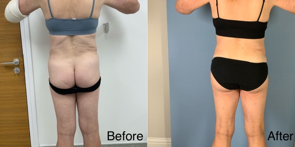 A Brazilian Butt Lift, or BBL, is a body contouring procedure that can be tailored to transgender, non-binary and gender non-conforming patients that wish to enhance their lower body to better reflect their gender identity. Transgender Brazilian Butt Lift In London