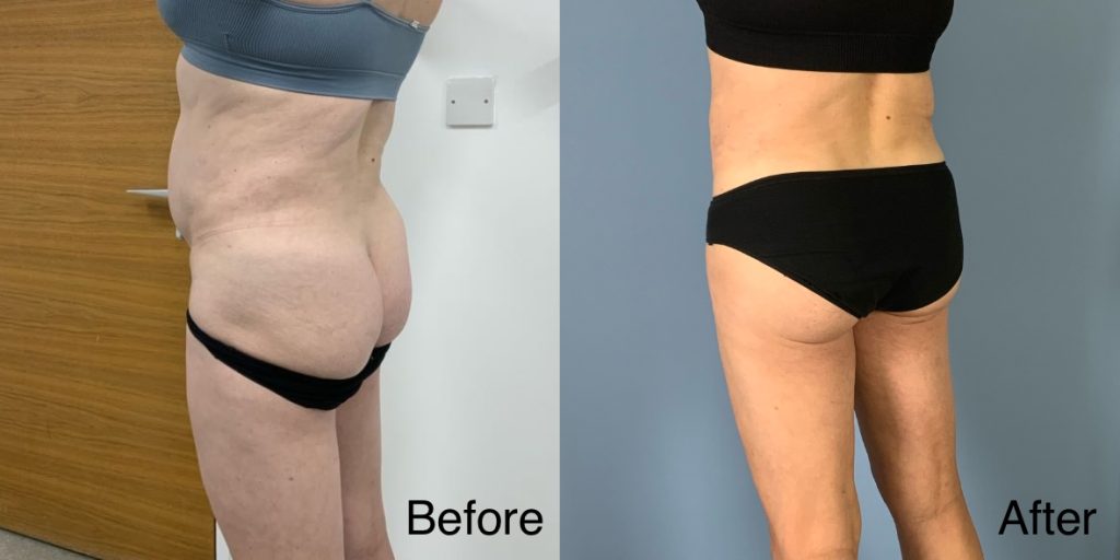 A Brazilian Butt Lift, or BBL, is a body contouring procedure that can be tailored to transgender, non-binary and gender non-conforming patients that wish to enhance their lower body to better reflect their gender identity. Transgender Brazilian Butt Lift In London