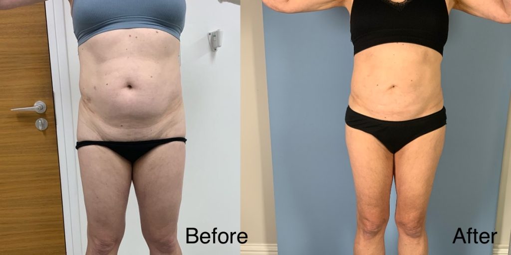 A Brazilian Butt Lift, or BBL, is a body contouring procedure that can be tailored to transgender, non-binary and gender non-conforming patients that wish to enhance their lower body to better reflect their gender identity. Transgender Brazilian Butt Lift In London