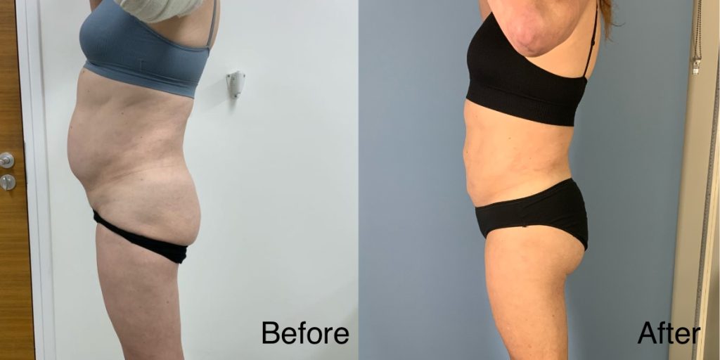 A Brazilian Butt Lift, or BBL, is a body contouring procedure that can be tailored to transgender, non-binary and gender non-conforming patients that wish to enhance their lower body to better reflect their gender identity. Transgender Brazilian Butt Lift In London