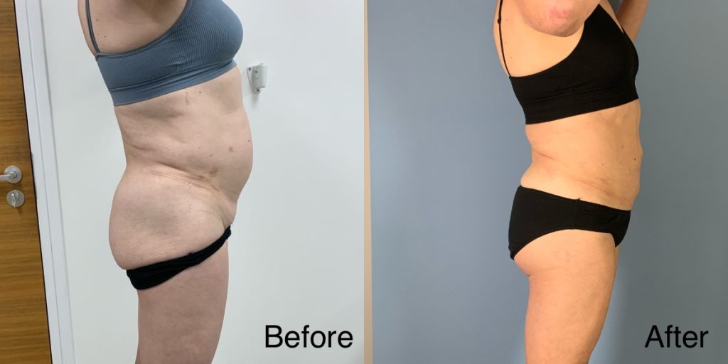 A Brazilian Butt Lift, or BBL, is a body contouring procedure that can be tailored to transgender, non-binary and gender non-conforming patients that wish to enhance their lower body to better reflect their gender identity. Transgender Brazilian Butt Lift In London