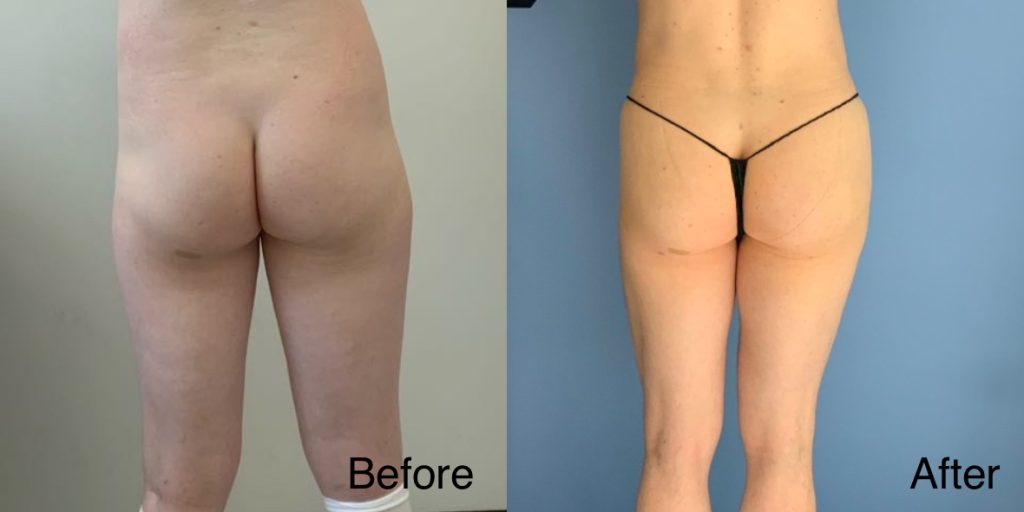 A Brazilian Butt Lift, or BBL, is a body contouring procedure that can be tailored to transgender, non-binary and gender non-conforming patients that wish to enhance their lower body to better reflect their gender identity. Transgender Brazilian Butt Lift In London