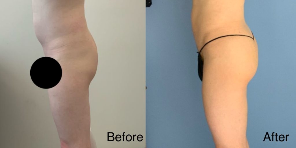 A Brazilian Butt Lift, or BBL, is a body contouring procedure that can be tailored to transgender, non-binary and gender non-conforming patients that wish to enhance their lower body to better reflect their gender identity. Transgender Brazilian Butt Lift In London