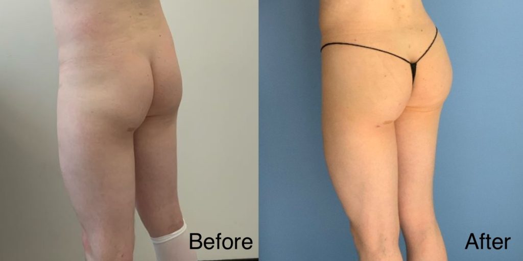 A Brazilian Butt Lift, or BBL, is a body contouring procedure that can be tailored to transgender, non-binary and gender non-conforming patients that wish to enhance their lower body to better reflect their gender identity. Transgender Brazilian Butt Lift In London