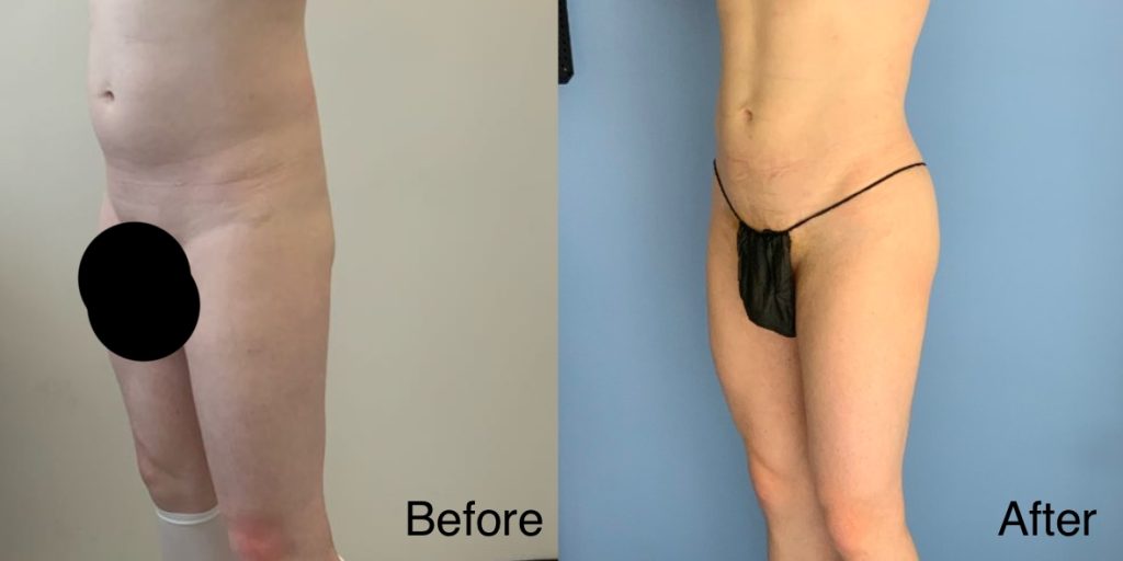 A Brazilian Butt Lift, or BBL, is a body contouring procedure that can be tailored to transgender, non-binary and gender non-conforming patients that wish to enhance their lower body to better reflect their gender identity. Transgender Brazilian Butt Lift In London