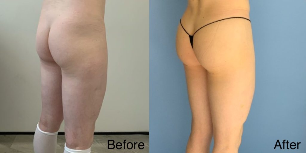 A Brazilian Butt Lift, or BBL, is a body contouring procedure that can be tailored to transgender, non-binary and gender non-conforming patients that wish to enhance their lower body to better reflect their gender identity. Transgender Brazilian Butt Lift In London