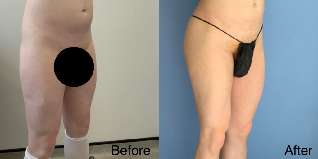 A Brazilian Butt Lift, or BBL, is a body contouring procedure that can be tailored to transgender, non-binary and gender non-conforming patients that wish to enhance their lower body to better reflect their gender identity. Transgender Brazilian Butt Lift In London