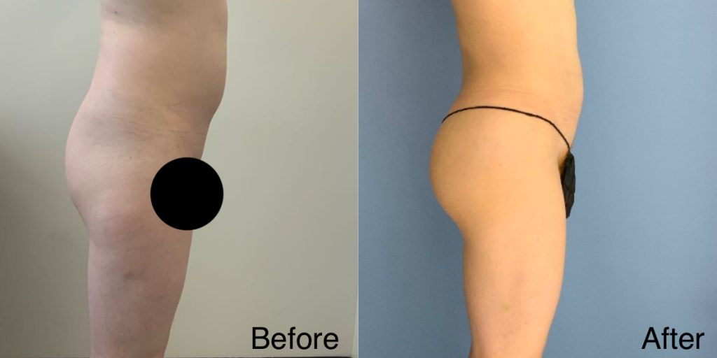 A Brazilian Butt Lift, or BBL, is a body contouring procedure that can be tailored to transgender, non-binary and gender non-conforming patients that wish to enhance their lower body to better reflect their gender identity. Transgender Brazilian Butt Lift In London