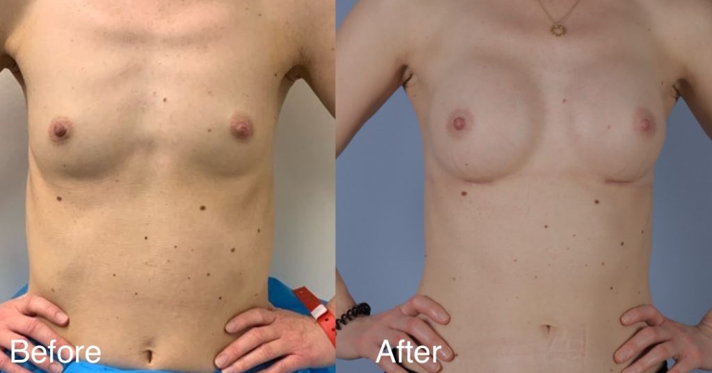 Feminising breast augmentation enhances volume and shape to create a fuller, more traditionally feminine upper body. This can be achieved using medical-grade silicone implants, fat transfer, or a combination of both – known as composite breast augmentation. Breast Augmentation &Amp; Mtf Top Surgery