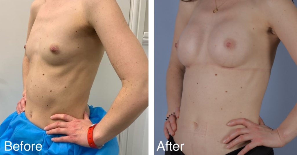 Feminising breast augmentation enhances volume and shape to create a fuller, more traditionally feminine upper body. This can be achieved using medical-grade silicone implants, fat transfer, or a combination of both – known as composite breast augmentation. Breast Augmentation &Amp; Mtf Top Surgery