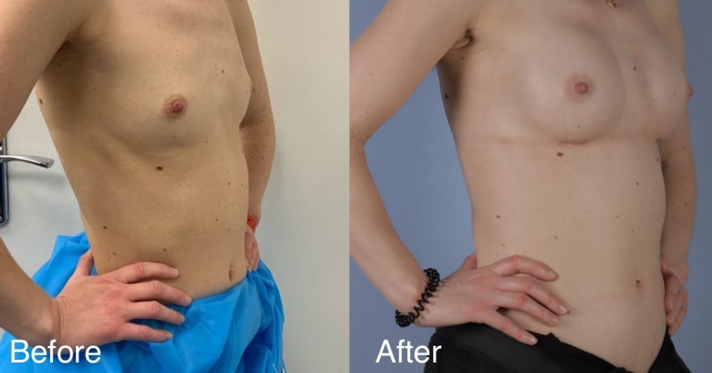 Feminising breast augmentation enhances volume and shape to create a fuller, more traditionally feminine upper body. This can be achieved using medical-grade silicone implants, fat transfer, or a combination of both – known as composite breast augmentation. Breast Augmentation &Amp; Mtf Top Surgery