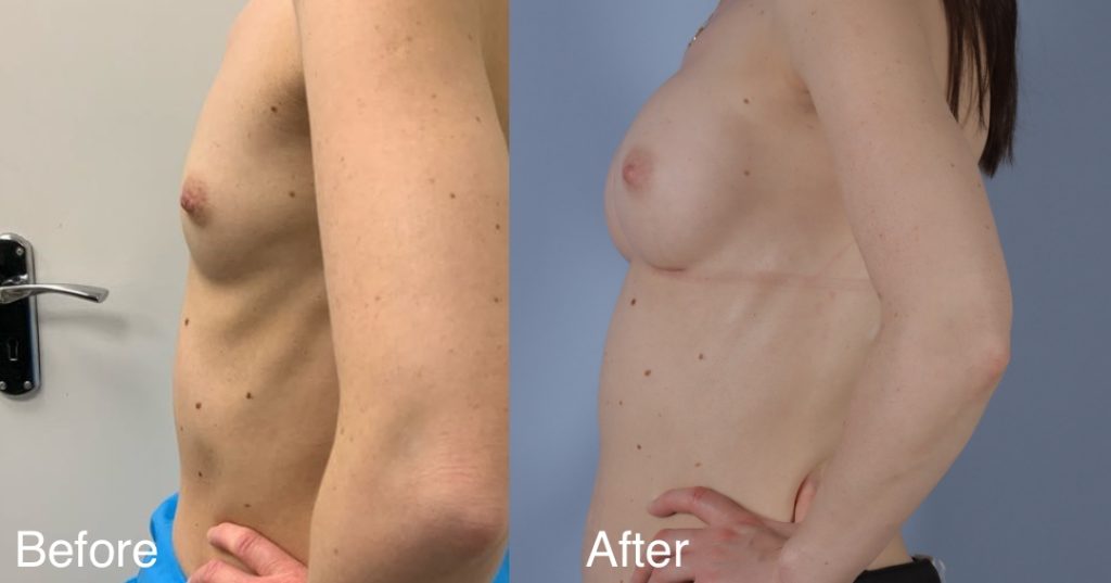Feminising breast augmentation enhances volume and shape to create a fuller, more traditionally feminine upper body. This can be achieved using medical-grade silicone implants, fat transfer, or a combination of both – known as composite breast augmentation. Breast Augmentation &Amp; Mtf Top Surgery