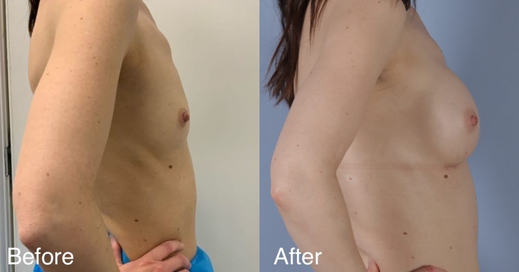 Feminising breast augmentation enhances volume and shape to create a fuller, more traditionally feminine upper body. This can be achieved using medical-grade silicone implants, fat transfer, or a combination of both – known as composite breast augmentation. Breast Augmentation &Amp; Mtf Top Surgery