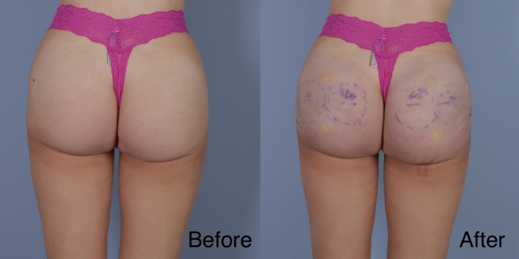 HYAcorp fillers are a hyaluronic acid (HA) based dermal filler that can help to add volume to the buttocks and hips. In the context of gender affirming care, HYAcorp can be used to enhance the contours of the figure through targeted injections to create a more feminine or masculine form. Dermal Fillers