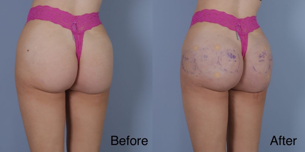 HYAcorp fillers are a hyaluronic acid (HA) based dermal filler that can help to add volume to the buttocks and hips. In the context of gender affirming care, HYAcorp can be used to enhance the contours of the figure through targeted injections to create a more feminine or masculine form. Dermal Fillers
