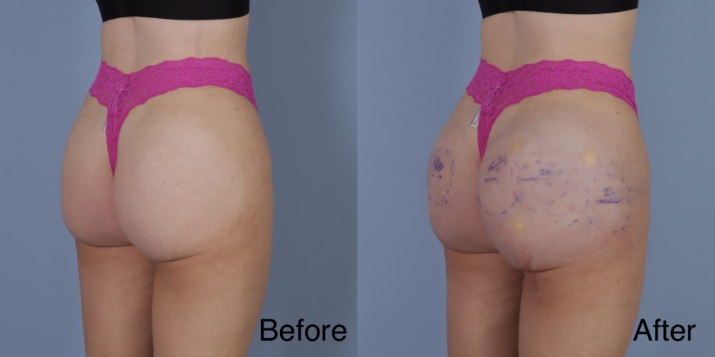 HYAcorp fillers are a hyaluronic acid (HA) based dermal filler that can help to add volume to the buttocks and hips. In the context of gender affirming care, HYAcorp can be used to enhance the contours of the figure through targeted injections to create a more feminine or masculine form. Dermal Fillers