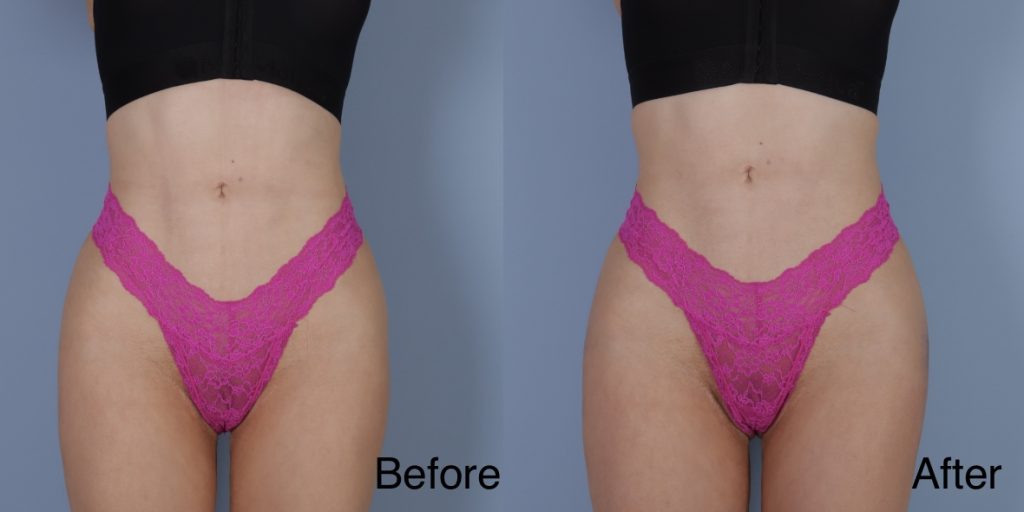 HYAcorp fillers are a hyaluronic acid (HA) based dermal filler that can help to add volume to the buttocks and hips. In the context of gender affirming care, HYAcorp can be used to enhance the contours of the figure through targeted injections to create a more feminine or masculine form. Dermal Fillers