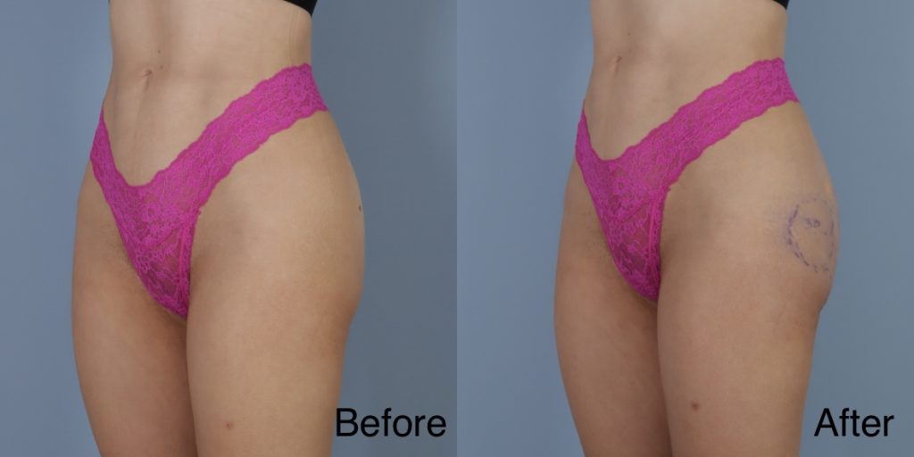 HYAcorp fillers are a hyaluronic acid (HA) based dermal filler that can help to add volume to the buttocks and hips. In the context of gender affirming care, HYAcorp can be used to enhance the contours of the figure through targeted injections to create a more feminine or masculine form. Dermal Fillers