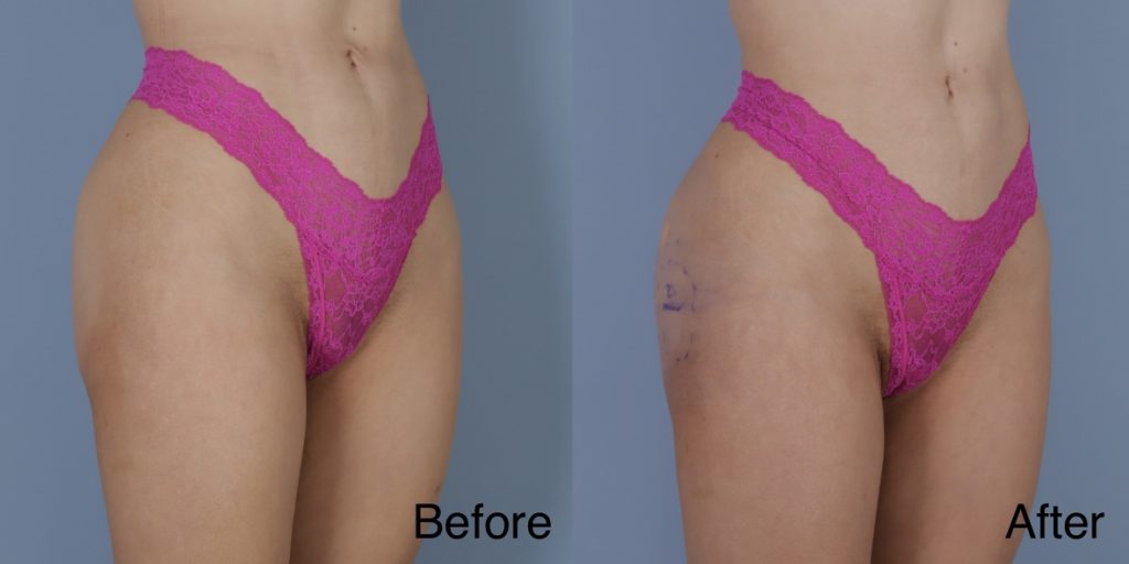 HYAcorp fillers are a hyaluronic acid (HA) based dermal filler that can help to add volume to the buttocks and hips. In the context of gender affirming care, HYAcorp can be used to enhance the contours of the figure through targeted injections to create a more feminine or masculine form. Dermal Fillers