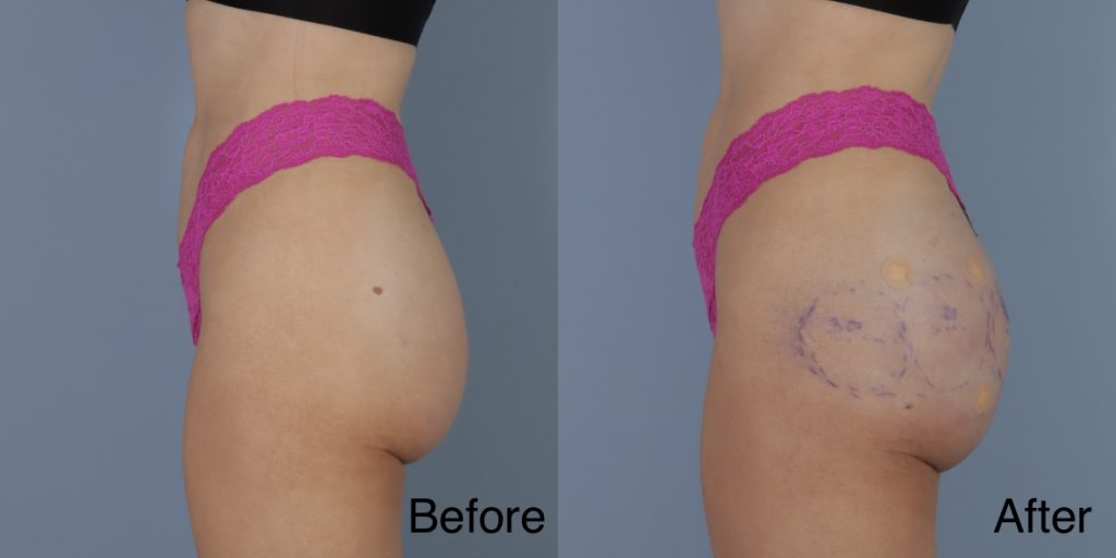 HYAcorp fillers are a hyaluronic acid (HA) based dermal filler that can help to add volume to the buttocks and hips. In the context of gender affirming care, HYAcorp can be used to enhance the contours of the figure through targeted injections to create a more feminine or masculine form. Dermal Fillers