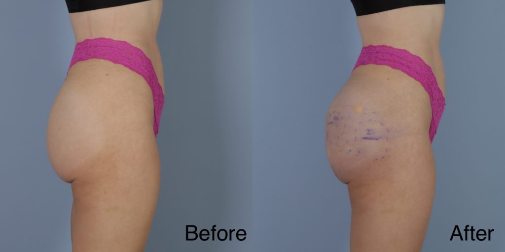 HYAcorp fillers are a hyaluronic acid (HA) based dermal filler that can help to add volume to the buttocks and hips. In the context of gender affirming care, HYAcorp can be used to enhance the contours of the figure through targeted injections to create a more feminine or masculine form. Dermal Fillers