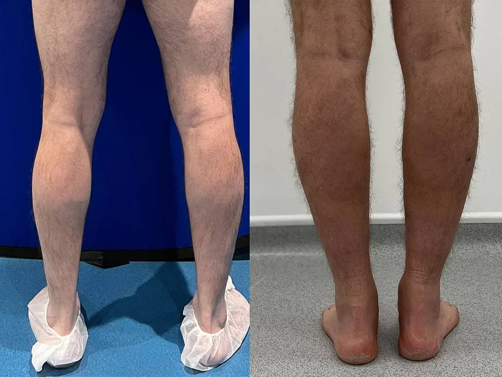 Calf augmentation enhances the shape and volume of the calves for a more masculine contour, through the use of medical-grade silicone implants, fat transfer, or a combination of both methods. Calf Implants And Augmentation For Trans Men &Amp; Nonbinary Individuals