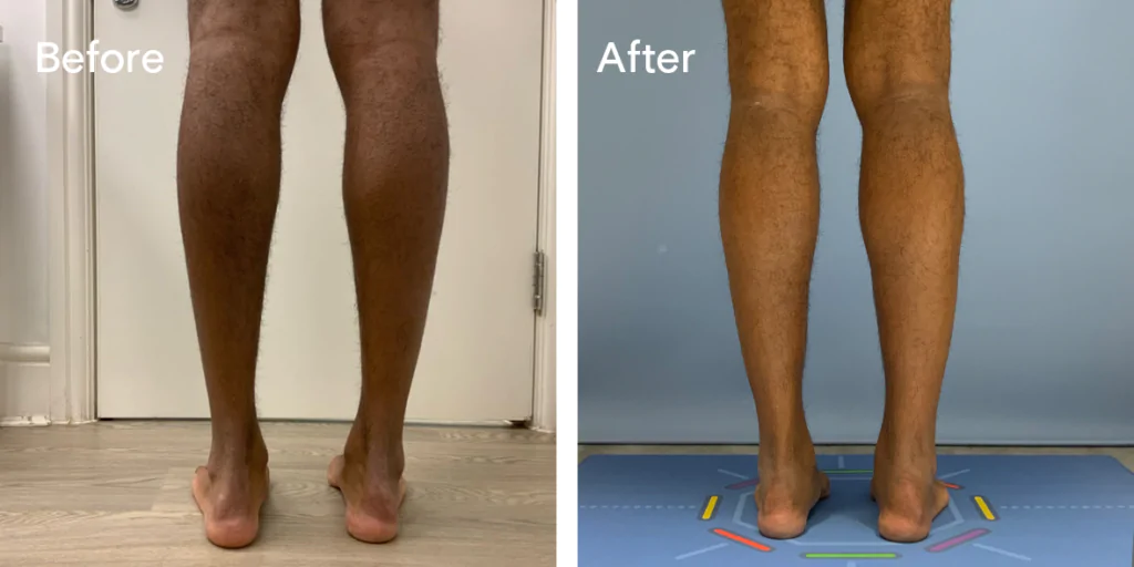 Calf augmentation enhances the shape and volume of the calves for a more masculine contour, through the use of medical-grade silicone implants, fat transfer, or a combination of both methods. Calf Implants And Augmentation For Trans Men &Amp; Nonbinary Individuals