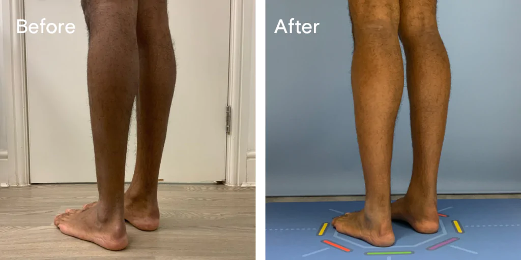 Calf augmentation enhances the shape and volume of the calves for a more masculine contour, through the use of medical-grade silicone implants, fat transfer, or a combination of both methods. Calf Implants And Augmentation For Trans Men &Amp; Nonbinary Individuals