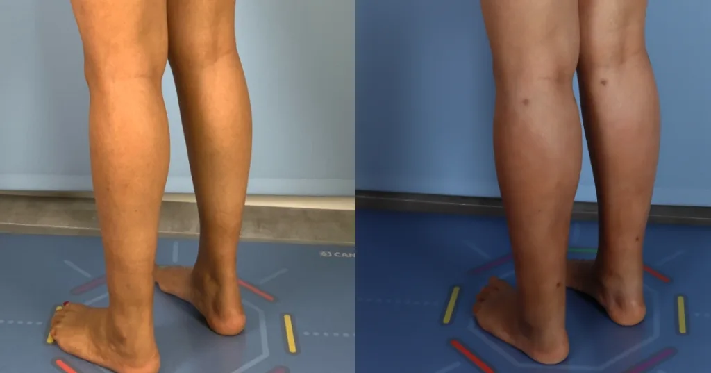 Calf augmentation enhances the shape and volume of the calves for a more masculine contour, through the use of medical-grade silicone implants, fat transfer, or a combination of both methods. Calf Implants And Augmentation For Trans Men &Amp; Nonbinary Individuals