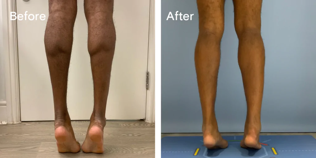 Calf augmentation enhances the shape and volume of the calves for a more masculine contour, through the use of medical-grade silicone implants, fat transfer, or a combination of both methods. Calf Implants And Augmentation For Trans Men &Amp; Nonbinary Individuals