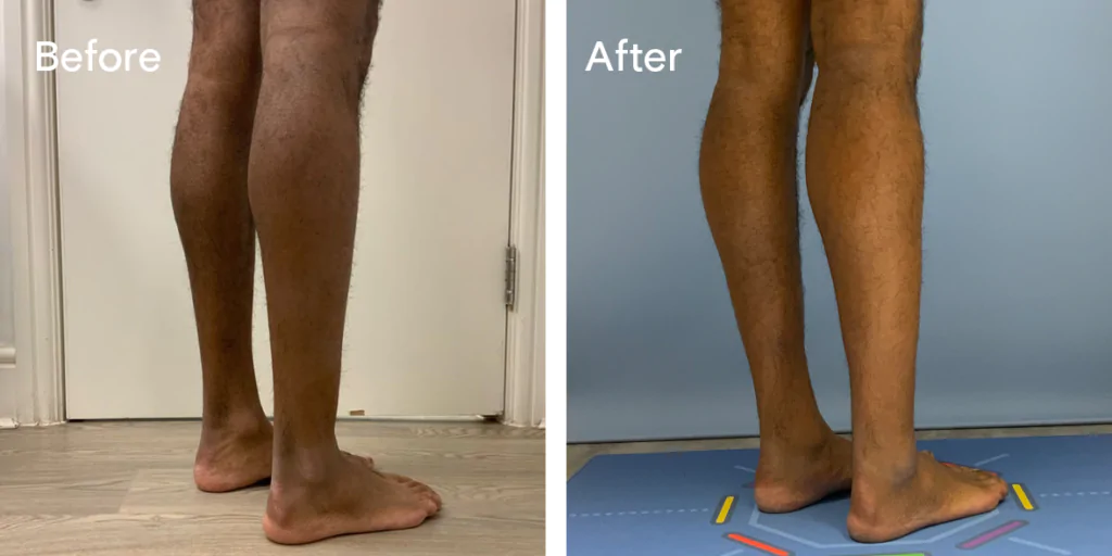 Calf augmentation enhances the shape and volume of the calves for a more masculine contour, through the use of medical-grade silicone implants, fat transfer, or a combination of both methods. Calf Implants And Augmentation For Trans Men &Amp; Nonbinary Individuals
