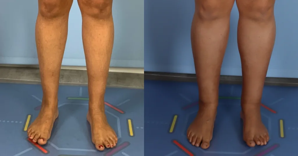 Calf augmentation enhances the shape and volume of the calves for a more masculine contour, through the use of medical-grade silicone implants, fat transfer, or a combination of both methods. Calf Implants And Augmentation For Trans Men &Amp; Nonbinary Individuals