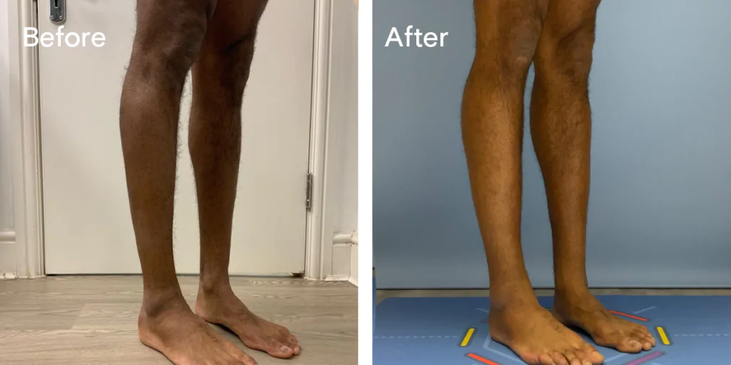 Calf augmentation enhances the shape and volume of the calves for a more masculine contour, through the use of medical-grade silicone implants, fat transfer, or a combination of both methods. Calf Implants And Augmentation For Trans Men &Amp; Nonbinary Individuals