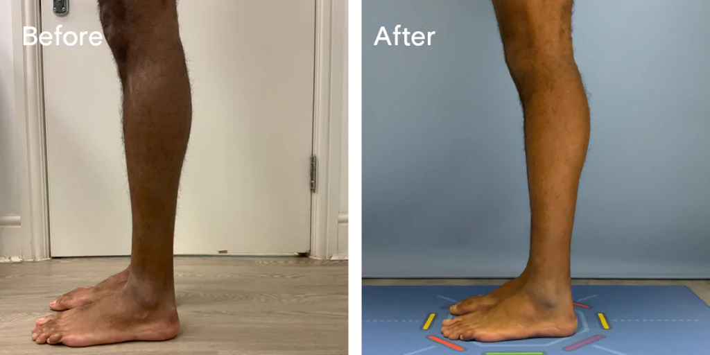 Calf augmentation enhances the shape and volume of the calves for a more masculine contour, through the use of medical-grade silicone implants, fat transfer, or a combination of both methods. Calf Implants And Augmentation For Trans Men &Amp; Nonbinary Individuals